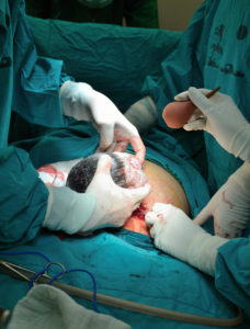 cesarean birth, elective